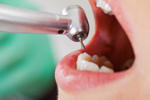 Best Urgent Care for Lost Fillings or Crowns in Olney, MD